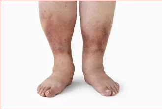 People with sedentary lifestyles, fatigue, or swelling